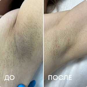 Лазерная эпиляция