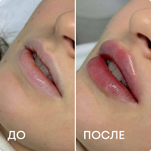 Увеличение губ