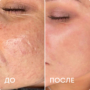 Микроигольчатый rf-лифтинг