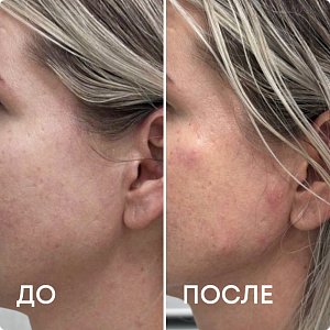 Липолитики