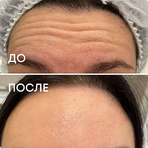 Ботулинотерапия (лоб и ботокс)