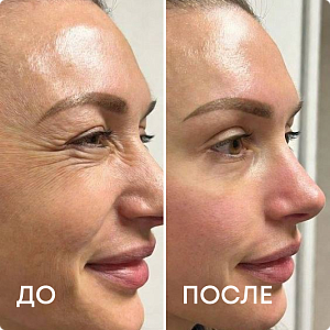 Ботулинотерапия (ботокс)