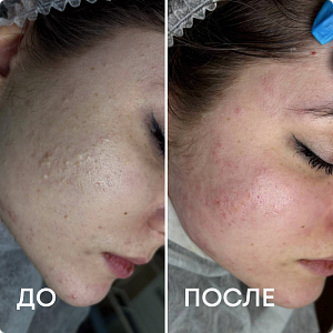 Чистка лица