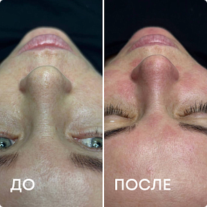Чистка лица-1