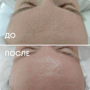 Фракционная мезотерапия